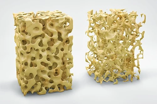 Bone-Density Bone-Density