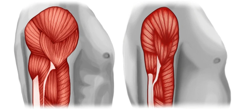 Sarcopenia Sarcopenia