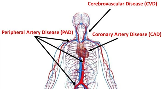 Cardiovascular and cerebrovascular disease